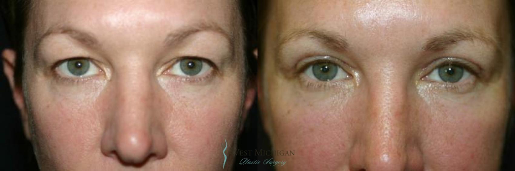 Before & After Eyelid Surgery Case 8738 View #1 View in Portage, Kalamazoo, Battle Creek, Michigan