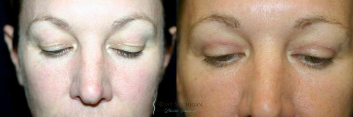 Before & After Eyelid Surgery Case 8738 View #2 View in Portage, Kalamazoo, Battle Creek, Michigan