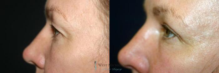 Before & After Eyelid Surgery Case 8738 View #3 View in Portage, Kalamazoo, Battle Creek, Michigan