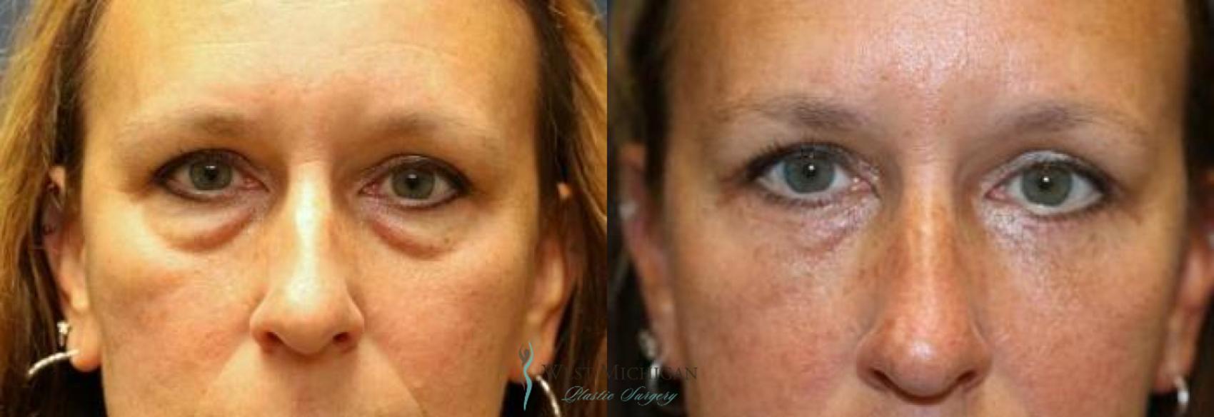 Before & After Eyelid Surgery Case 8842 View #1 View in Portage, Kalamazoo, Battle Creek, Michigan