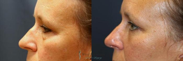Before & After Eyelid Surgery Case 8842 View #2 View in Portage, Kalamazoo, Battle Creek, Michigan
