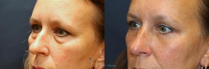 Before & After Eyelid Surgery Case 8842 View #3 View in Portage, Kalamazoo, Battle Creek, Michigan