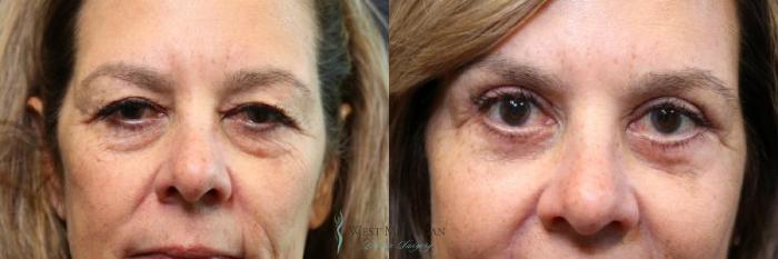 Before & After Eyelid Surgery Case 8843 View #1 View in Portage, Kalamazoo, Battle Creek, Michigan