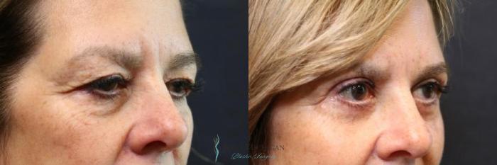 Before & After Eyelid Surgery Case 8843 View #3 View in Portage, Kalamazoo, Battle Creek, Michigan