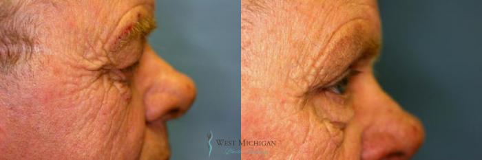 Before & After Eyelid Surgery Case 8844 View #2 View in Portage, Kalamazoo, Battle Creek, Michigan