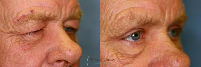 Before & After Eyelid Surgery Case 8844 View #3 View in Portage, Kalamazoo, Battle Creek, Michigan