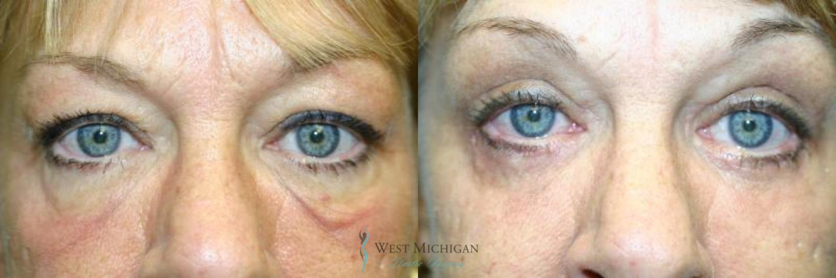 Before & After Eyelid Surgery Case 8845 View #1 View in Portage, Kalamazoo, Battle Creek, Michigan