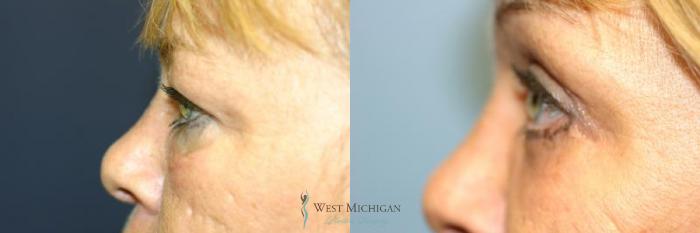 Before & After Eyelid Surgery Case 8845 View #2 View in Portage, Kalamazoo, Battle Creek, Michigan