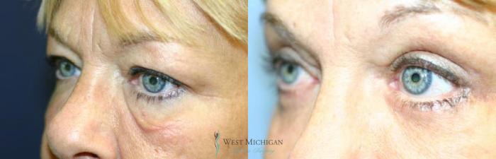 Before & After Eyelid Surgery Case 8845 View #3 View in Portage, Kalamazoo, Battle Creek, Michigan
