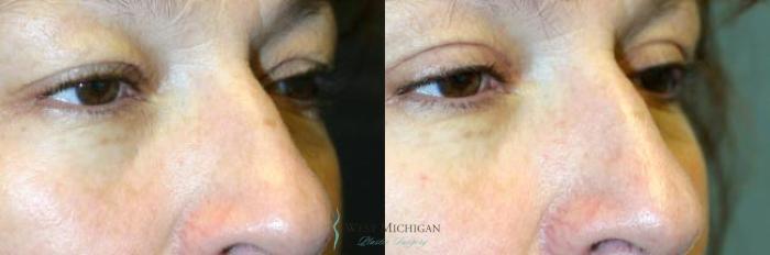 Before & After Eyelid Surgery Case 8846 View #2 View in Portage, Kalamazoo, Battle Creek, Michigan