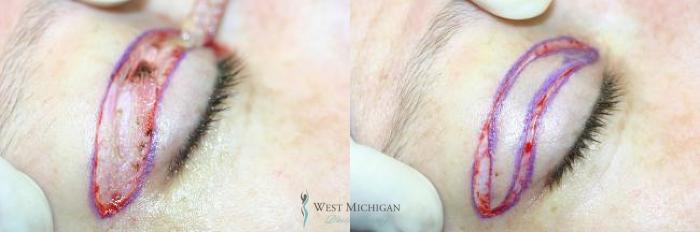 Before & After Eyelid Surgery Case 8846 View #3 View in Portage, Kalamazoo, Battle Creek, Michigan