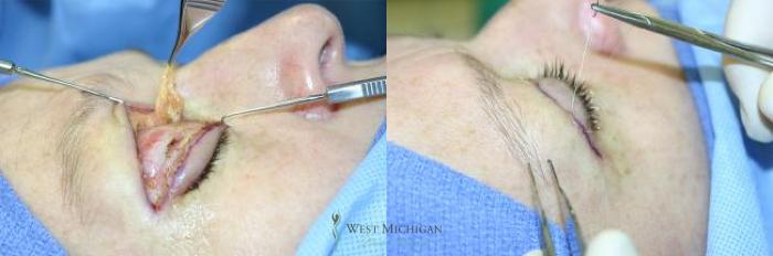 Before & After Eyelid Surgery Case 8846 View #4 View in Kalamazoo & Grand Rapids, Michigan