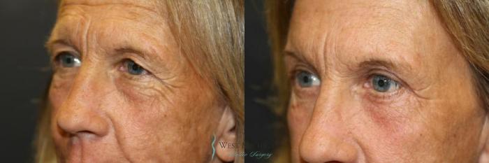 Before & After Eyelid Surgery Case 8847 View #3 View in Portage, Kalamazoo, Battle Creek, Michigan
