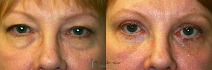 Before & After Eyelid Surgery Case 8848 View #1 View in Portage, Kalamazoo, Battle Creek, Michigan