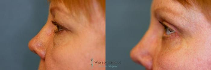 Before & After Eyelid Surgery Case 8848 View #2 View in Kalamazoo & Grand Rapids, Michigan