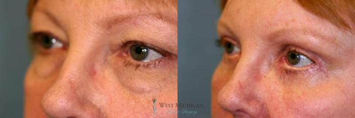 Before & After Eyelid Surgery Case 8848 View #3 View in Kalamazoo & Grand Rapids, Michigan