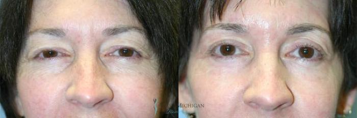 Before & After Eyelid Surgery Case 8849 View #1 View in Portage, Kalamazoo, Battle Creek, Michigan