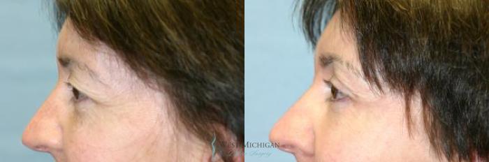Before & After Eyelid Surgery Case 8849 View #2 View in Portage, Kalamazoo, Battle Creek, Michigan