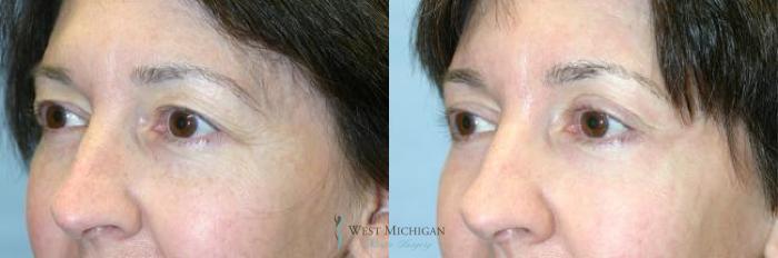 Before & After Eyelid Surgery Case 8849 View #3 View in Portage, Kalamazoo, Battle Creek, Michigan