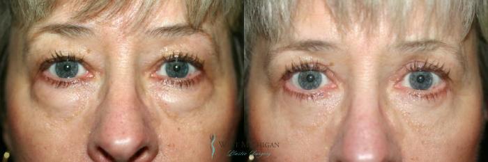 Before & After Eyelid Surgery Case 8850 View #1 View in Portage, Kalamazoo, Battle Creek, Michigan