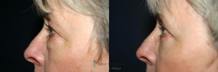 Before & After Eyelid Surgery Case 8850 View #2 View in Portage, Kalamazoo, Battle Creek, Michigan