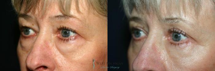 Before & After Eyelid Surgery Case 8850 View #3 View in Portage, Kalamazoo, Battle Creek, Michigan