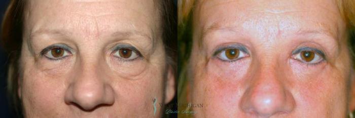 Before & After Eyelid Surgery Case 8851 View #1 View in Kalamazoo & Grand Rapids, Michigan