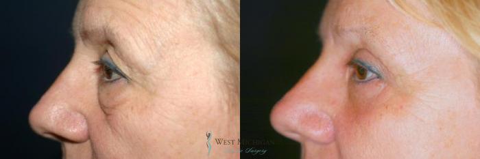 Before & After Eyelid Surgery Case 8851 View #2 View in Portage, Kalamazoo, Battle Creek, Michigan