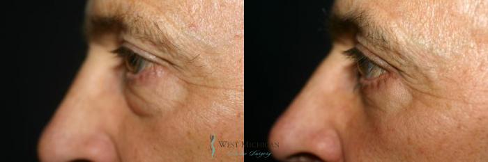 Before & After Eyelid Surgery Case 8852 View #2 View in Kalamazoo & Grand Rapids, Michigan