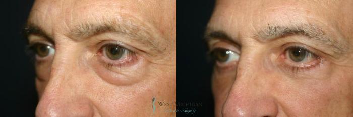 Before & After Eyelid Surgery Case 8852 View #3 View in Kalamazoo & Grand Rapids, Michigan