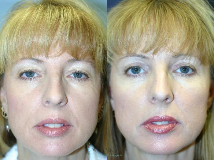 Before & After Eyelid Surgery Case 8853 View #1 View in Portage, Kalamazoo, Battle Creek, Michigan