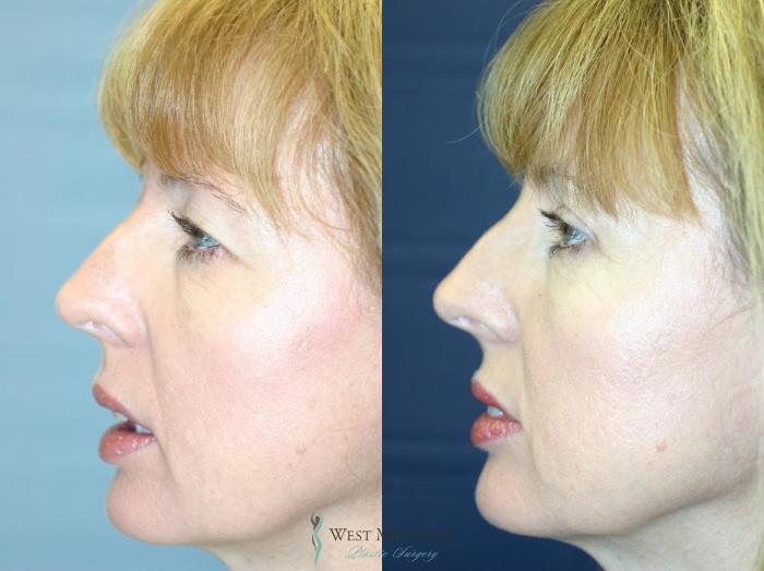 Before & After Eyelid Surgery Case 8853 View #2 View in Portage, Kalamazoo, Battle Creek, Michigan