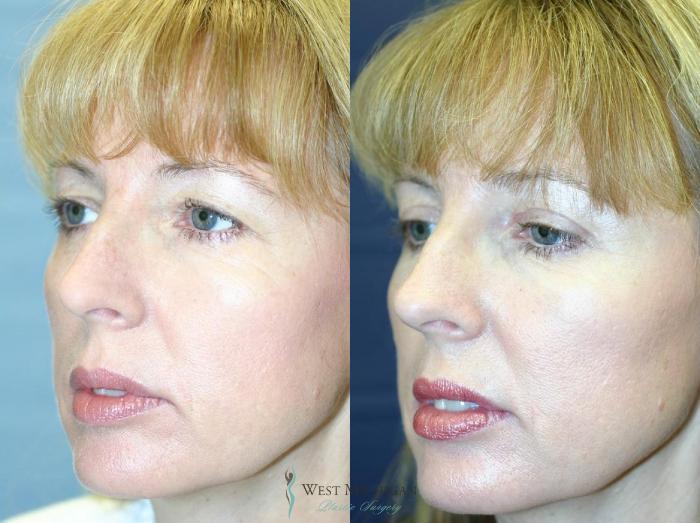 Before & After Eyelid Surgery Case 8853 View #3 View in Portage, Kalamazoo, Battle Creek, Michigan