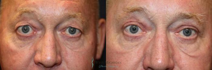 Before & After Eyelid Surgery Case 8854 View #1 View in Portage, Kalamazoo, Battle Creek, Michigan