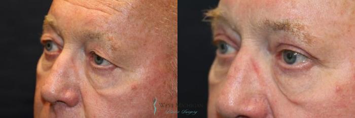 Before & After Eyelid Surgery Case 8854 View #3 View in Portage, Kalamazoo, Battle Creek, Michigan