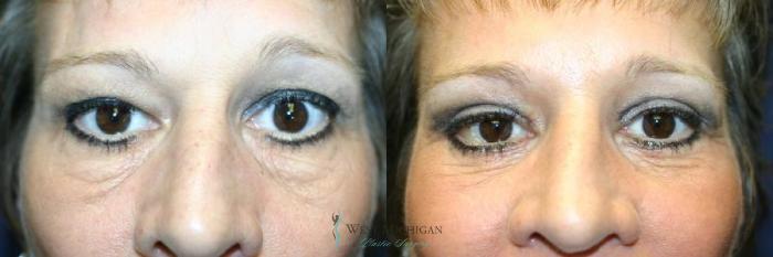 Before & After Eyelid Surgery Case 8855 View #1 View in Portage, Kalamazoo, Battle Creek, Michigan