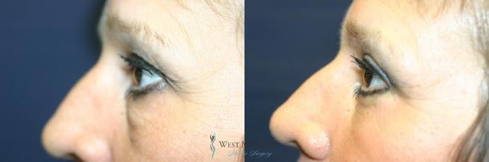 Before & After Eyelid Surgery Case 8855 View #2 View in Portage, Kalamazoo, Battle Creek, Michigan