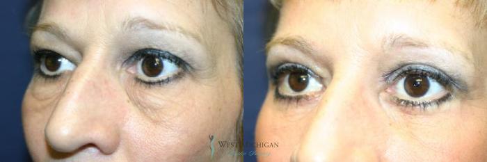 Before & After Eyelid Surgery Case 8855 View #3 View in Portage, Kalamazoo, Battle Creek, Michigan