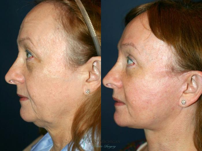 Before & After Eyelid Surgery Case 8739 View #2 View in Kalamazoo & Grand Rapids, Michigan