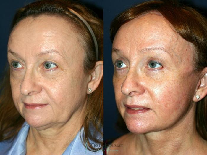 Before & After Eyelid Surgery Case 8739 View #3 View in Kalamazoo & Grand Rapids, Michigan