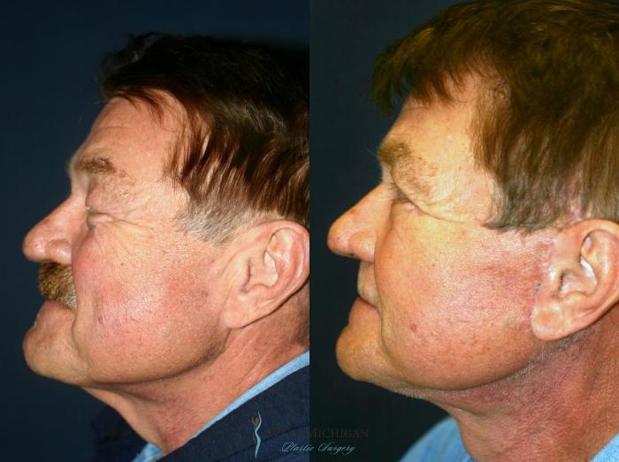 Before & After Facelift Case 8864 View #2 View in Kalamazoo & Grand Rapids, Michigan
