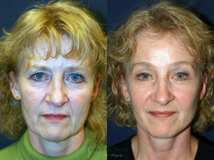 Before & After Facelift Case 8865 View #1 View in Kalamazoo & Grand Rapids, Michigan
