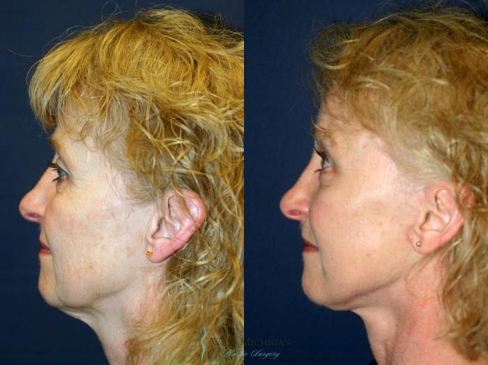 Before & After Brow Lift Case 8865 View #2 View in Kalamazoo & Grand Rapids, Michigan