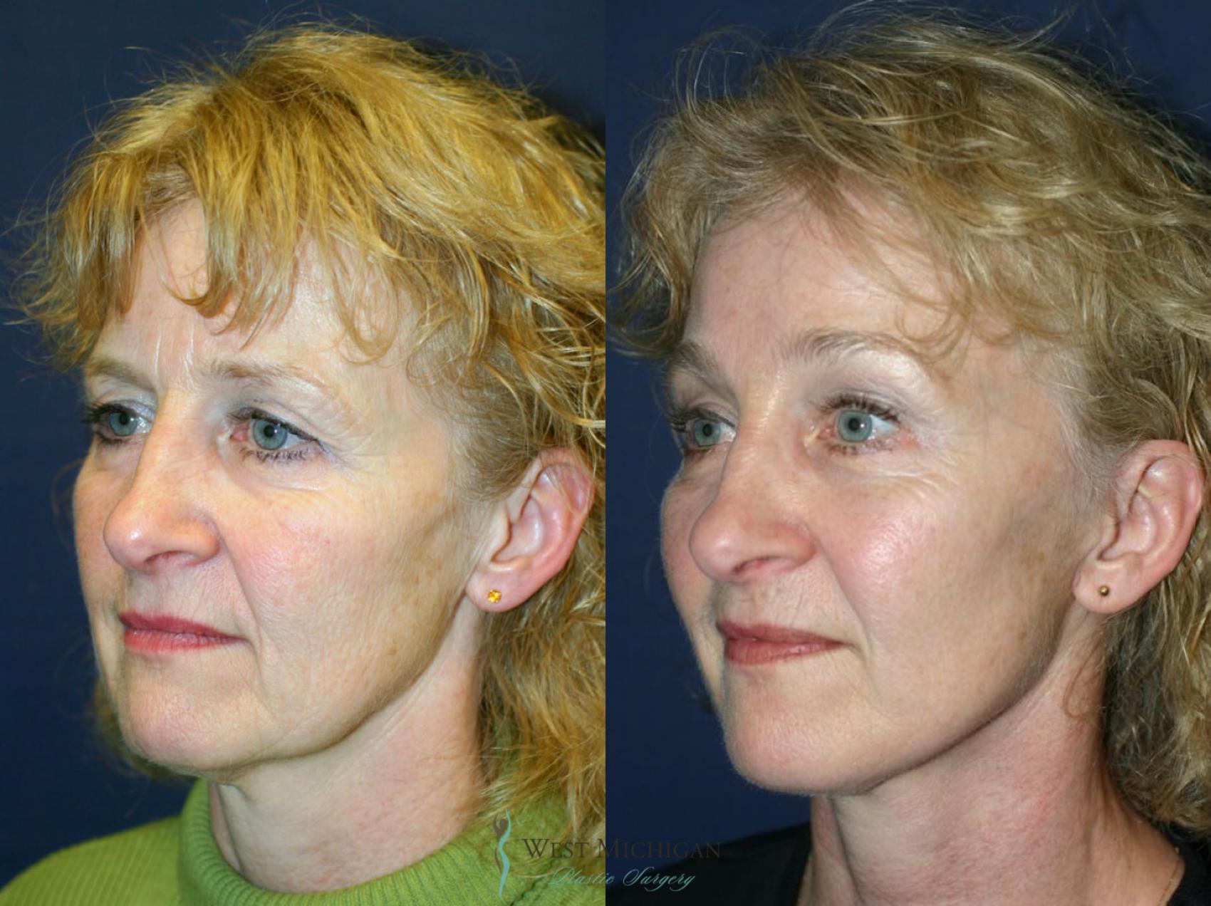 Before & After Facelift Case 8865 View #3 View in Portage, Kalamazoo, Battle Creek, Michigan