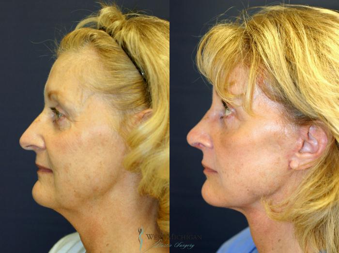 Before & After Nose Surgery Case 8866 View #2 View in Kalamazoo & Grand Rapids, Michigan