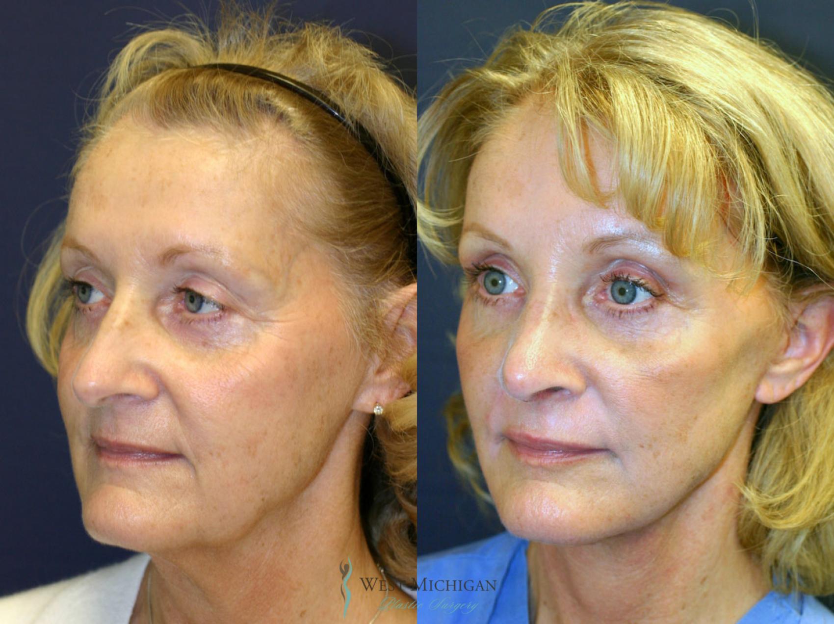 Before & After Eyelid Surgery Case 8866 View #3 View in Kalamazoo & Grand Rapids, Michigan