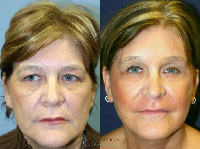 Before & After Brow Lift Case 8869 View #1 View in Kalamazoo & Grand Rapids, Michigan