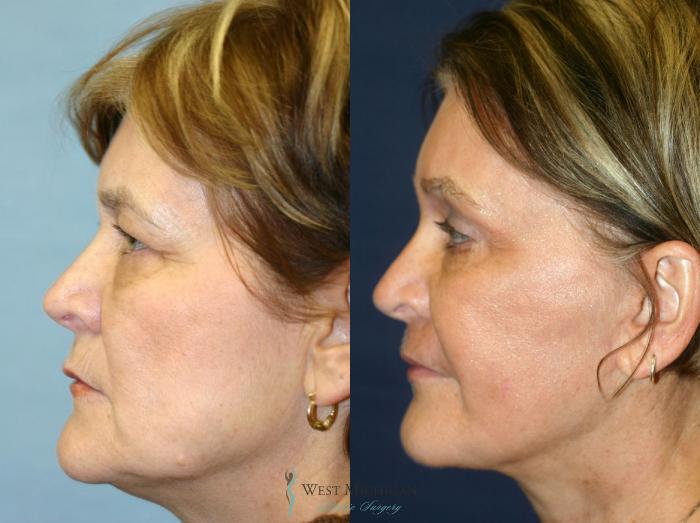Before & After Brow Lift Case 8869 View #2 View in Kalamazoo & Grand Rapids, Michigan