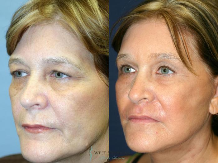 Before & After Eyelid Surgery Case 8869 View #3 View in Portage, Kalamazoo, Battle Creek, Michigan