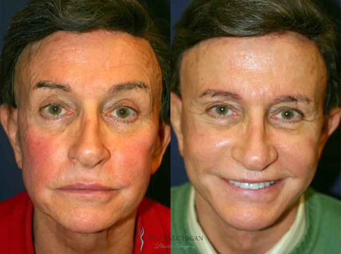 Before & After Facelift Case 8872 View #1 View in Kalamazoo & Grand Rapids, Michigan